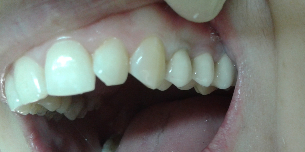  Протезирование верхних зубов металлокерамическими коронками