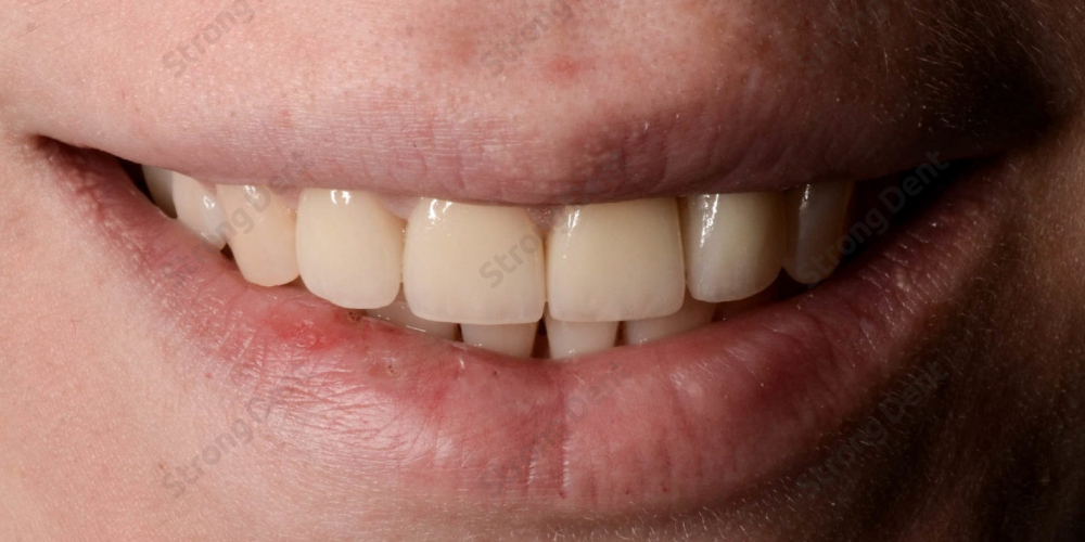  Результат установки высокоэстетичных виниров на передние зубы
