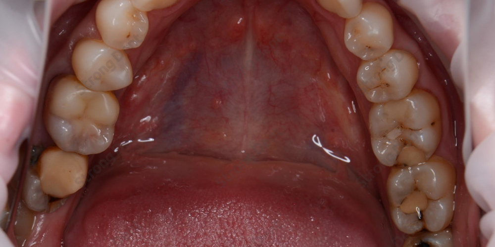  Протезирование зубов безметалловыми коронками