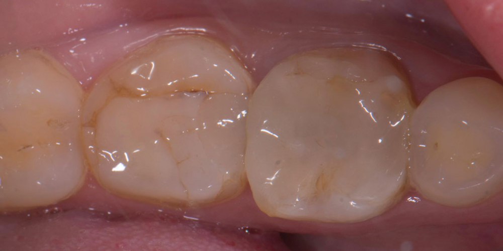  Восстановление двух зубов керамическими вкладками