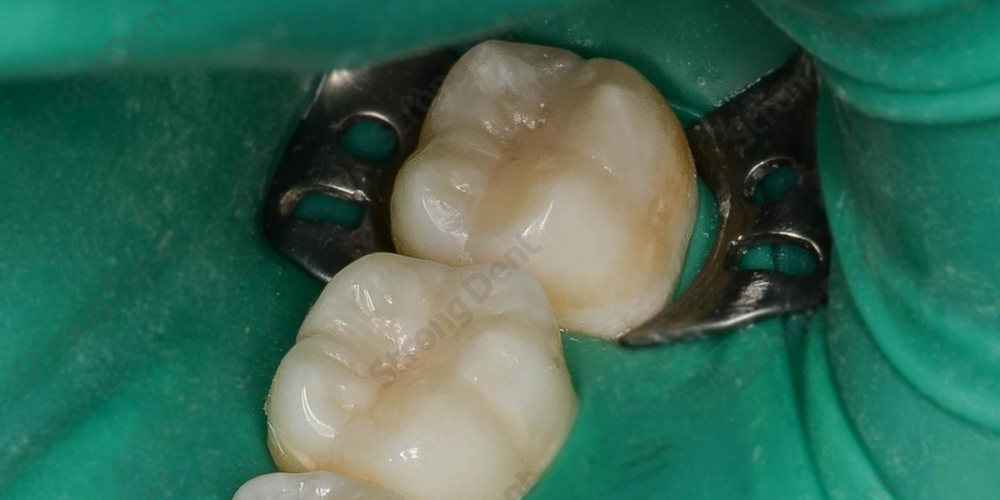  Результат восстановление зубов нанокомпозитной пломбой