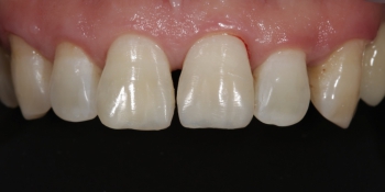 Реставрация передних зубов, ремонт скола фото после лечения