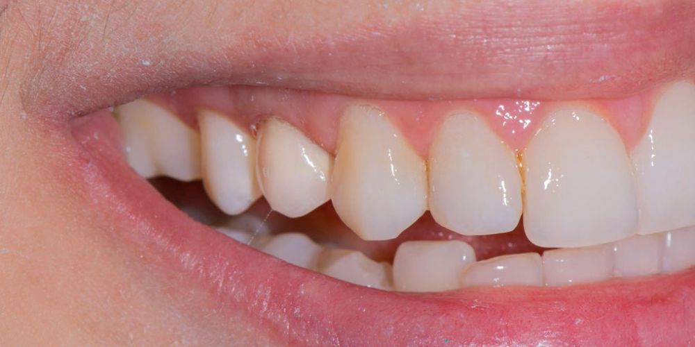  Реставрация зуба керамическим виниром в эстетически значимой зоне