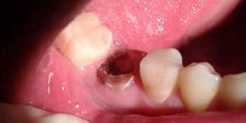 Восстановление 46 зуба культевой вкладкой и металлокерамической коронкой фото до лечения
