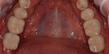 Протезирование зубов безметалловыми коронками фото после лечения