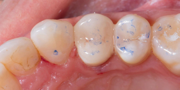 Реставрация зуба керамическим виниром в эстетически значимой зоне фото после лечения