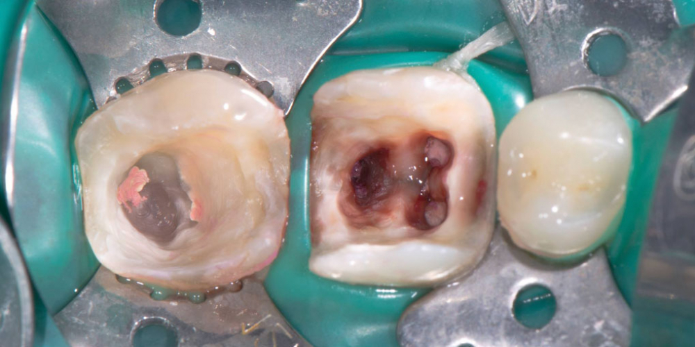  Восстановление двух зубов керамическими вкладками
