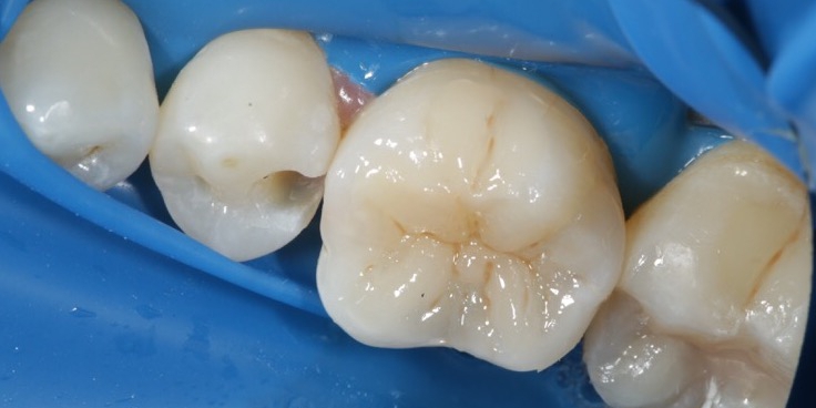  Реставрация и лечение кариеса жевательного зуба