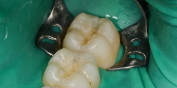 Результат восстановление зубов нанокомпозитной пломбой фото до лечения