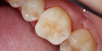 Реставрация и лечение кариеса жевательного зуба фото после лечения