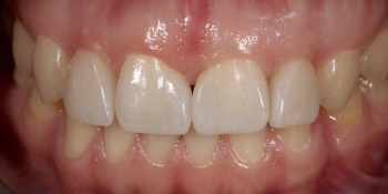 Закрытие диастемы и трем (щели) между зубами фото после лечения