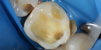 Реставрация и лечение кариеса жевательного зуба фото до лечения