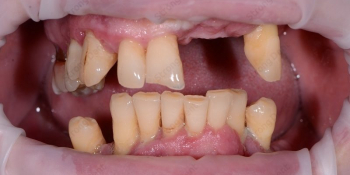 Имплантация при полной потере зубов, фото до и после фото до лечения
