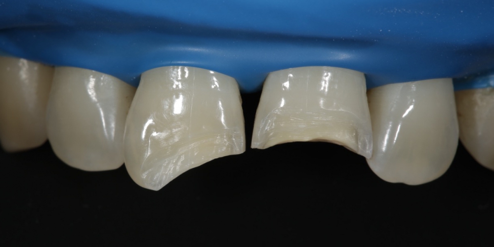  Реставрация передних зубов, ремонт скола