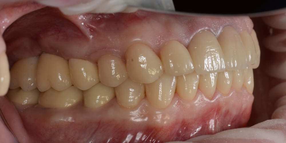 Фото после лечения, вед слева Тотальная реконструкция улыбки с протезированием на имплантах безметалловыми короноками и винирами