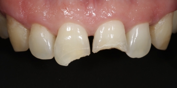 Реставрация передних зубов, ремонт скола фото до лечения