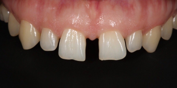 Закрытие диастемы и трем (щели) между зубами фото до лечения