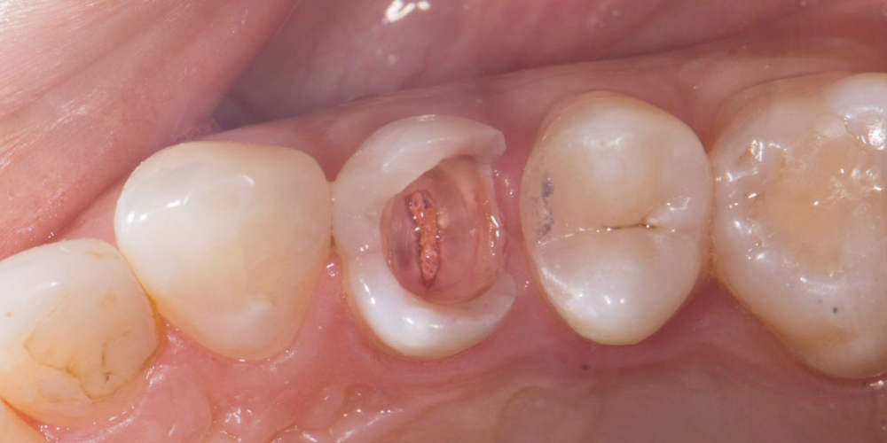  Реставрация зуба керамическим виниром в эстетически значимой зоне