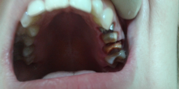 Протезирование верхних зубов металлокерамическими коронками фото до лечения