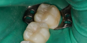 Результат восстановление зубов нанокомпозитной пломбой фото после лечения
